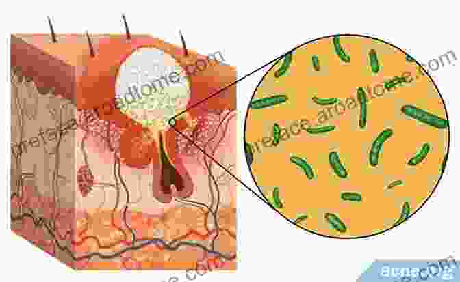 Microscopic Image Of Acne Causing Bacteria On The Skin Acne Remedies Organic Skin Care And Anti Aging Guide: Learn How To Attain A Clear Skin Naturally And Without Harmful Ingredients And How To Maintain Your Looks And Your Health At Any Age